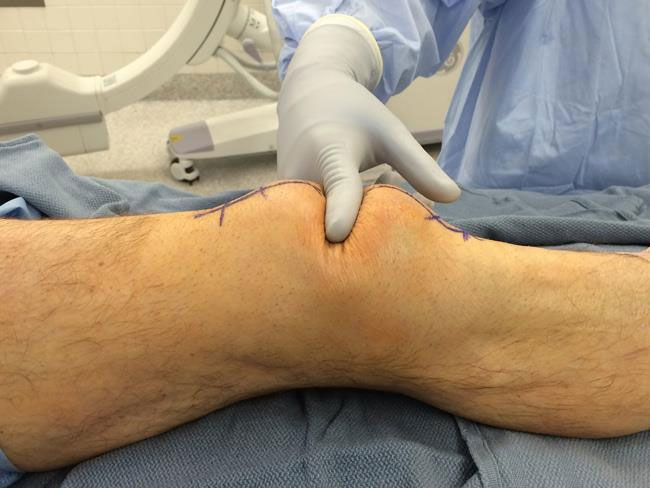 Simple & Complex Fracture Trauma & Soft Tissue Trauma