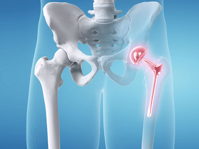 Joint Disorders & Joint Replacement Surgeries